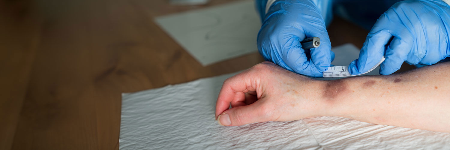A person wearing blue sterile gloves holds a measuring tape against the bruises on another person's arm.